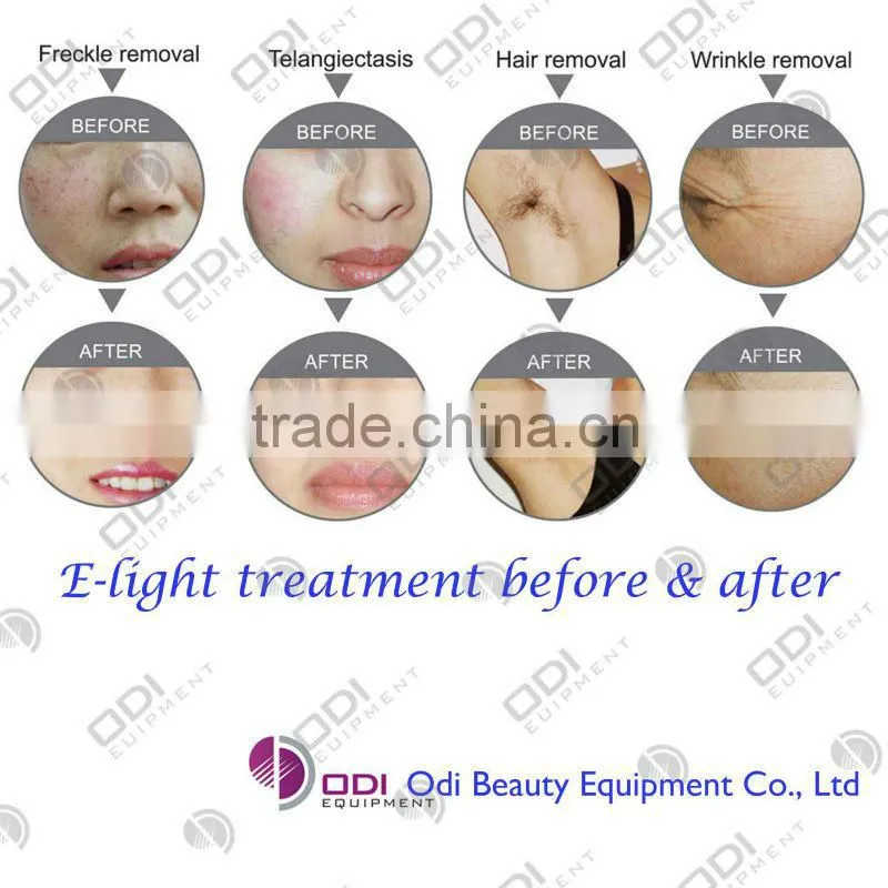 OD-E60 portable Pigmentation Correctors e light ipl rf beauty equipment