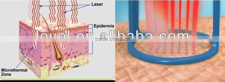 100% High Quality Skin Resurfacing Acne Scar Removal Fractional Co2 Laser Equipment