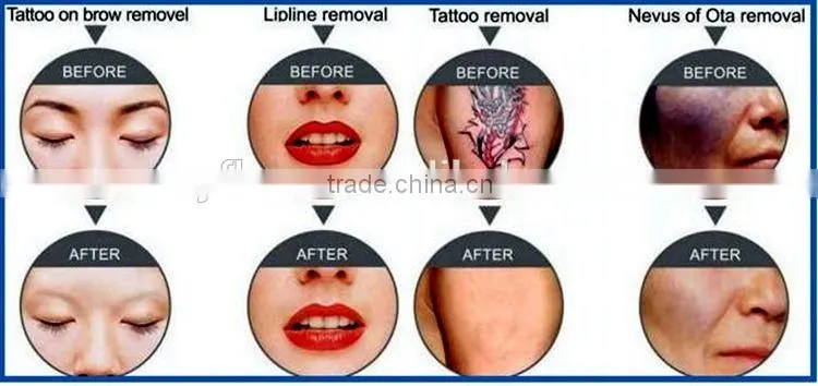 IPL+Elight+RF hair removal and skin rejuvenation 3 Handpieces laser skin machine