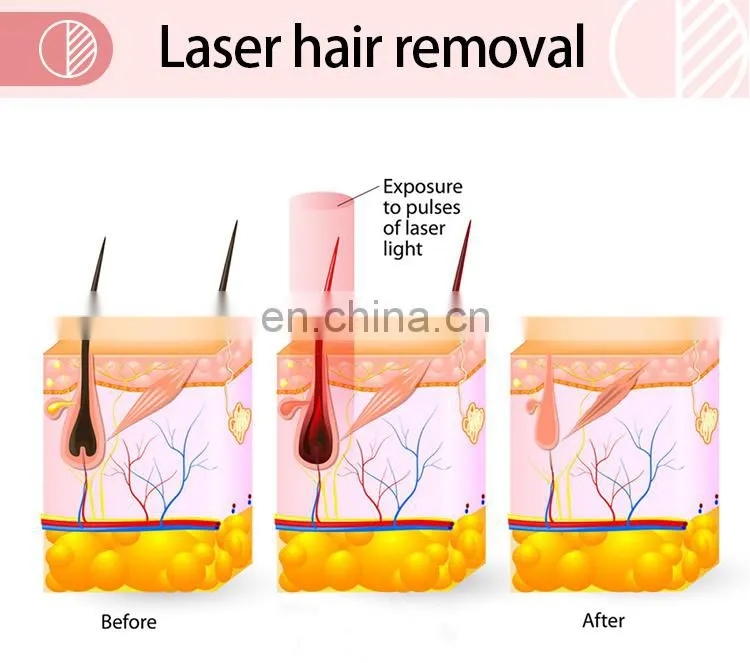 Fashion Design Big Spot Size 808nm Laser Diode Bar/chips 808 Diode Laser Hair Removal Beauty Machine