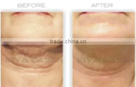 ultrasound cavitation slimming gel for cavitation