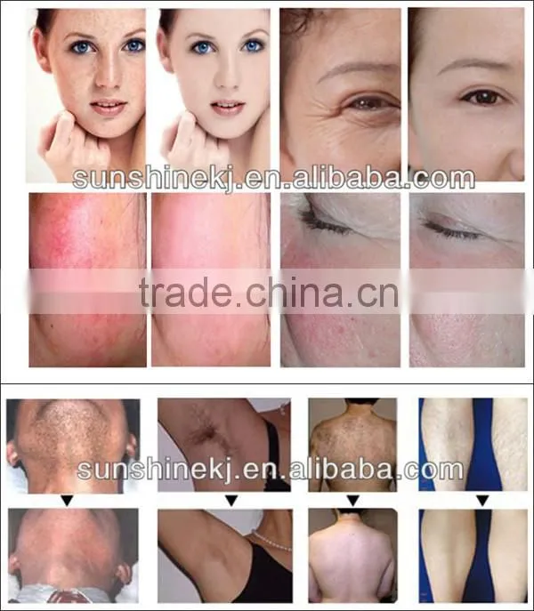 Salon Top best effective 2 in 1 e-light(ipl rf)beauty apparatus with CE/TUV certificates