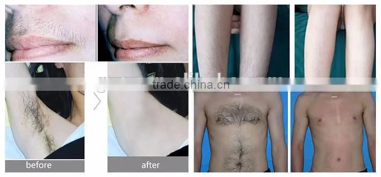 Best selling products 808nm diode laser hair removal machine for beauty salon equipment