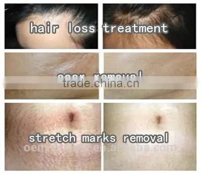 Most effective derma roller with 540 slender steel needles for home use