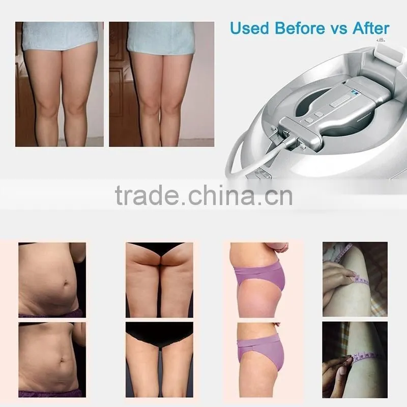 2017 slimming machine for body shaping and reducing striae of pregnancy
