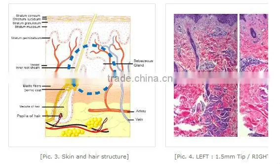 Top performance!!!! microneedle skin treatment portable fractional rf