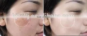 new hot professional Rhytidectomy Fraction new face dead skin remove
