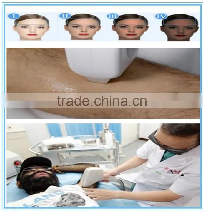 2016 professional diode laser 808nm laser hair removal machine for sale