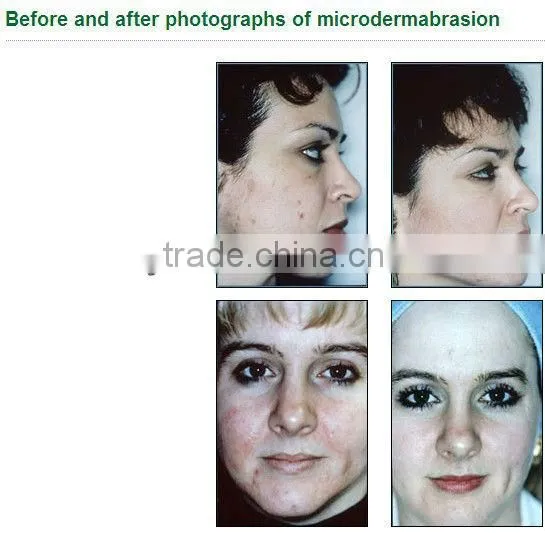 VY-300 Used microdermabrasion machines for sale