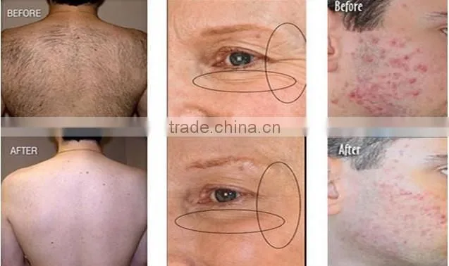 Best selling products hair loss treatment beauty device keyword 2014 best shr ipl machine price