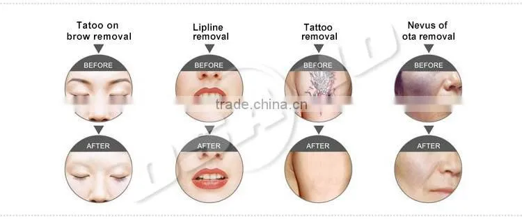 2015 Tattoo Removal Portable Q Switch Nd YAG Laser machine