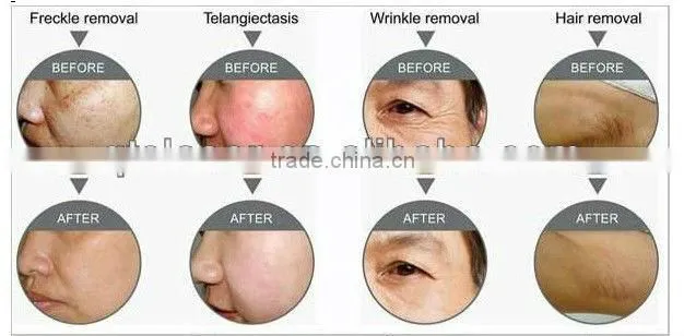 Alexandrite Laser Miami, Brown Spot Removal Miami