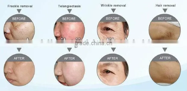 High performance chinese Multifunctional beauty machine