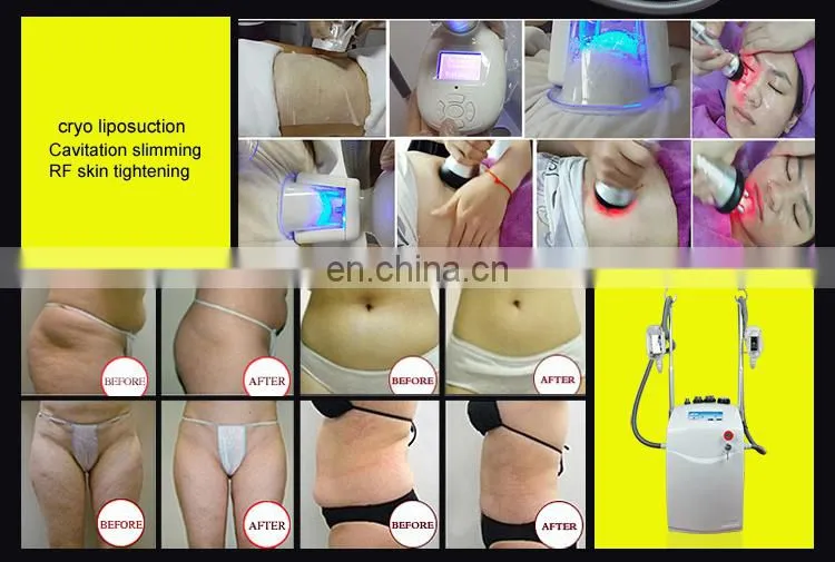 Hottest sale Cyro fat freeze machine / 2 cryo handle fat freeze slimming device