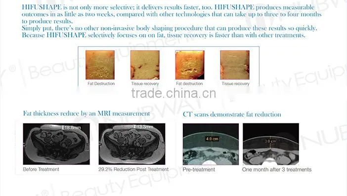Keep slim hifu beauty machine high intensity focused ultrasound hifu