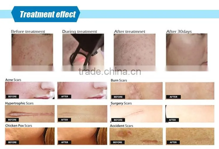 2016 New vertical laser machine with fractional laser co2 facial treatment