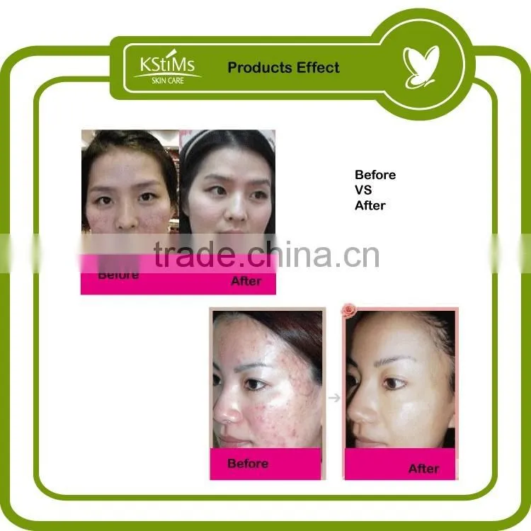 Japanese Green tea rose aloe vare acne melasma peeling removal treatment cream for oily skin