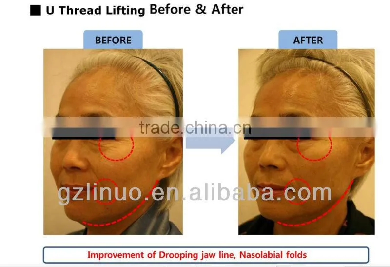 Dynamics of Thread Lifting ,Contour Thread Lift