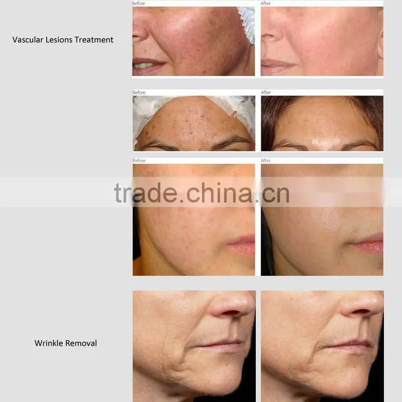 LINGMEI promotion home laser hair removal