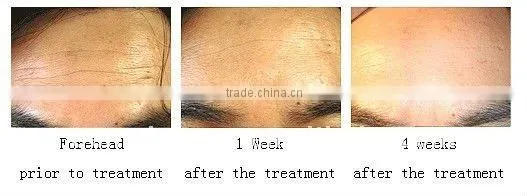 natural cosmetic auto micro needle roll handling galvanic derma roller L007