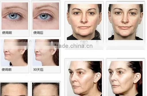AYJ A902 Carboxytherapy no needle facial mesotherapy Machine