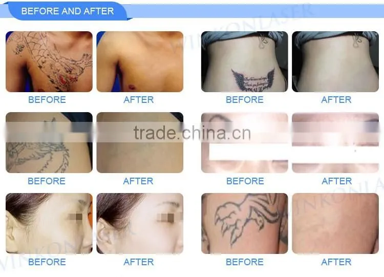 Wholesale portable tattoo removal e-light ipl rf+nd yag laser multifunction machine for skin care
