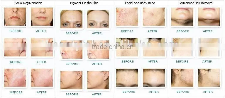 LINGMEI promotion home laser hair removal