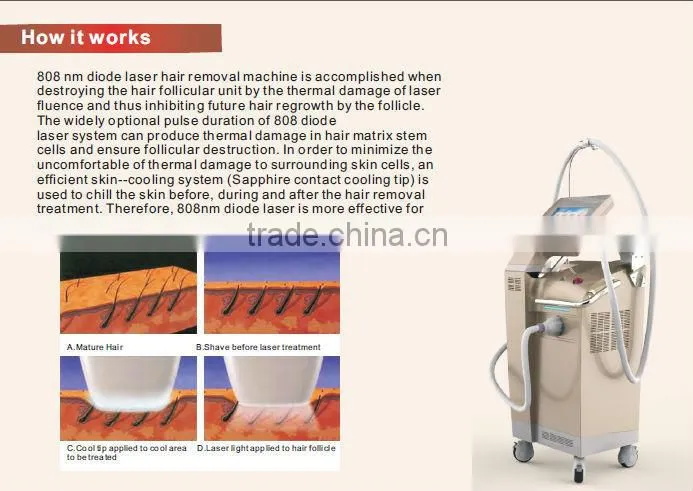 High power 808nm diode laser hair removal treatment