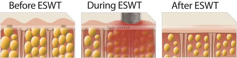 T&B distributor 1-10Hz slim face system eswt shape