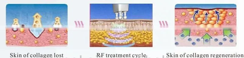 Try it and you will like it! RL-I01! lipo cavitation and radio frequency machine