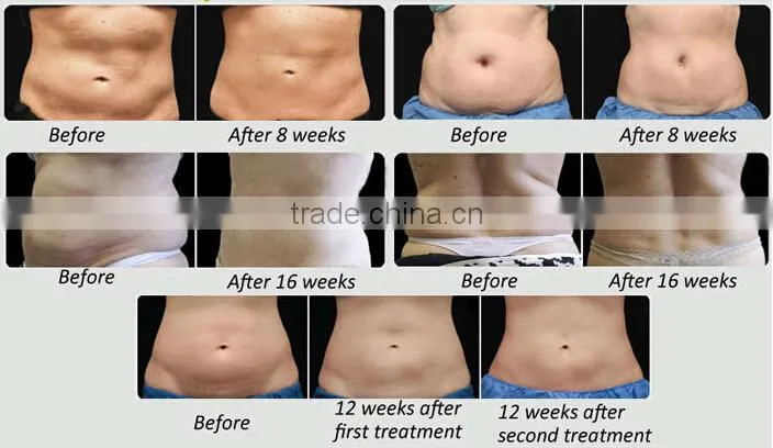 Best selling model 3 handles cryolipolysis fat freezing device