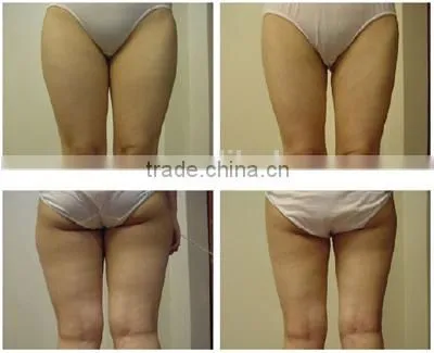 GS86 ultra lipo cavitation rf beauty slimming machine
