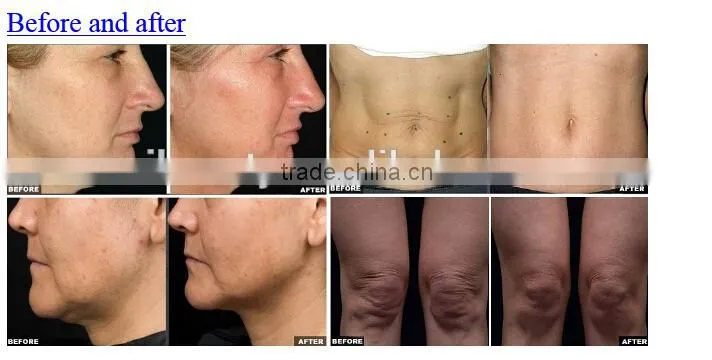 rejuvenation thermagic cpt eye bag removal skin care systems