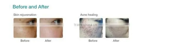 Apolo med LED PDT therapy for acne scar wrinkle PDT red light therapy portable