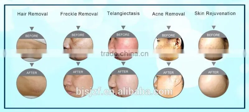 Most popular IPL Hair Removal and ipl facial rejuvenation machine