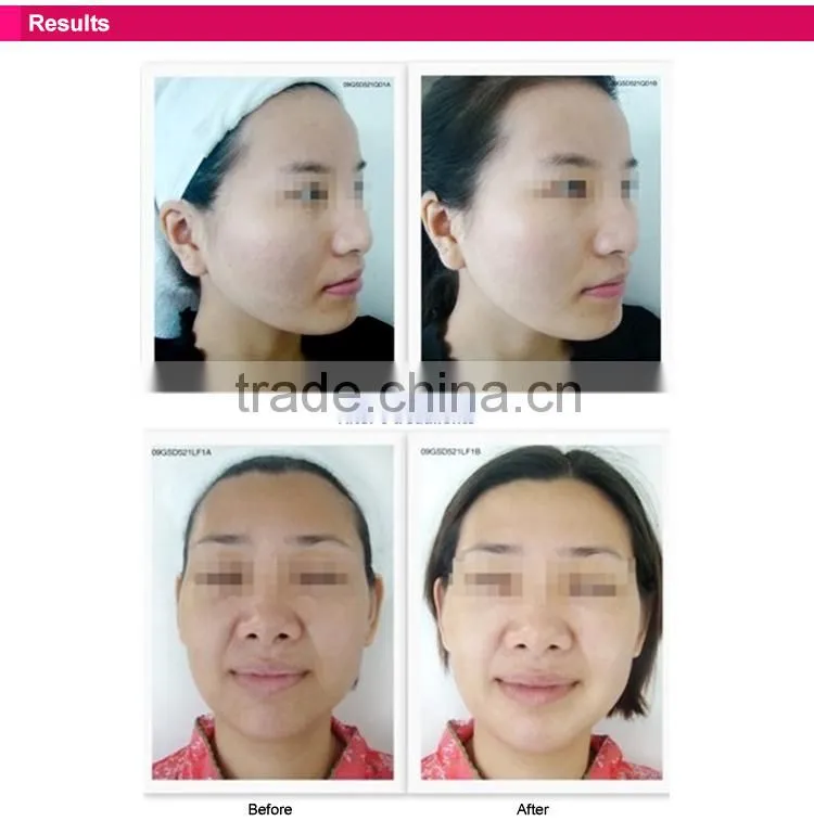 Home use RF wrinkle treatment/rf skin rejuvenation for sale