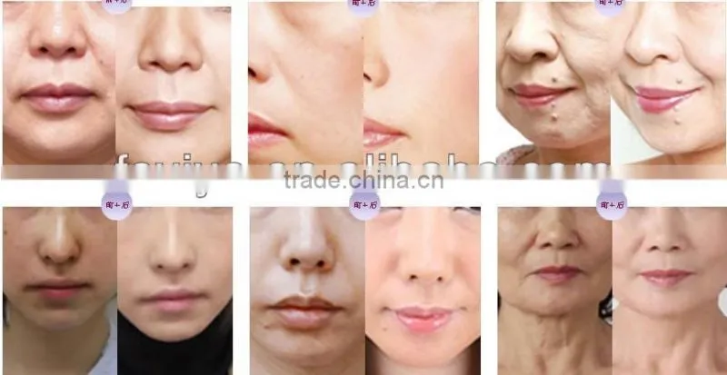 F998 Portable micro-needle fractional rf face lift machine