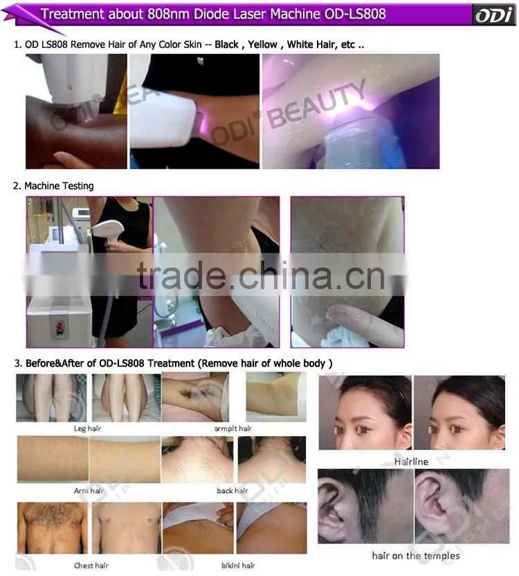 Fast result painless unhairing 808nm diode laser treatment