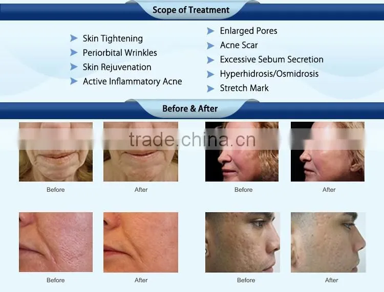 Professional rf fractional skin resurfacing
