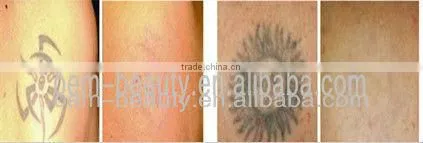 NEW RF skin rejuvenation ND YAG laser tattoo removal machine ipl elight for loss weight