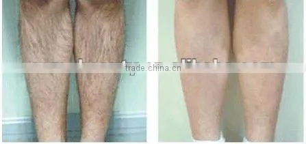 Constant Multi-pulse IPL Hair Removal &Skin Rejuvenation Beauty Machine-A005