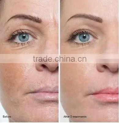 NL-SPA900 Facial Care Skin New Water Dermabrasion Diamond Microdermabrasion Machine acne scars treatment