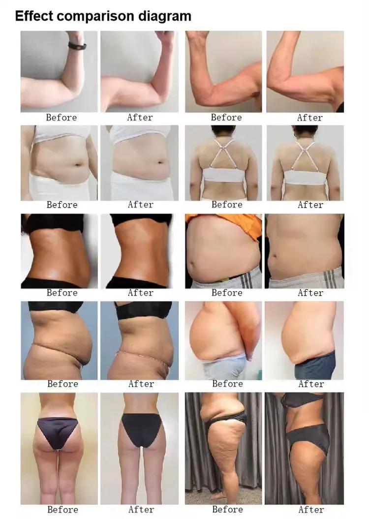 10d Laser Body Shape Machine Slim Cold Laser Therapy Device 10d Maxlipo Master 532nm Laser Machine