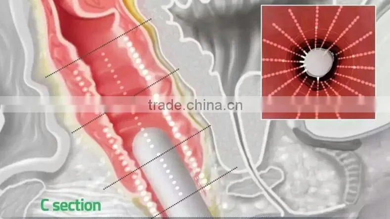 New arrival private rejuvenation vaginal tightening hifu system with 2 transducer