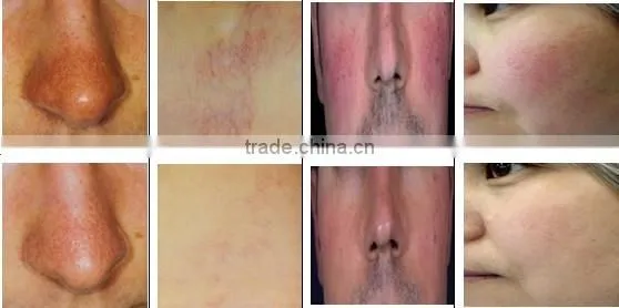 Hotsale Vein Stopper/ Vein Wave Machine/ Spider Vein Removal