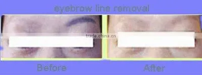 Q switch YAG laser tattoo removal