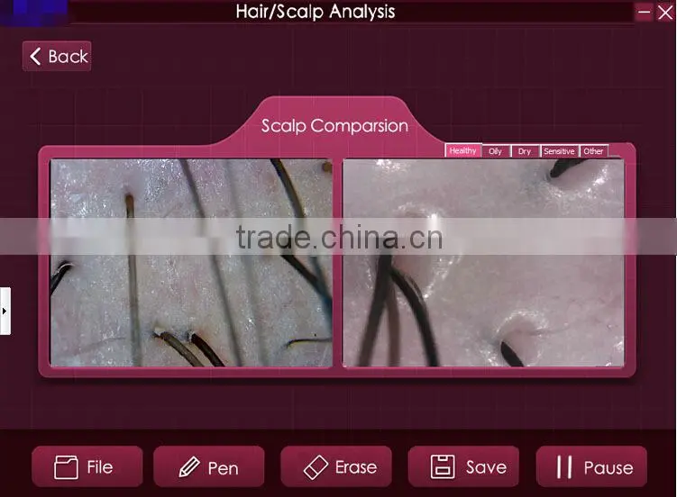 200X digital microscope scalp detector