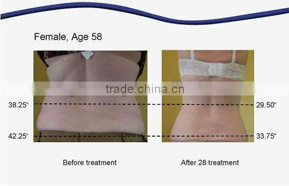 Lipo Laser Diode Laser Slimming Machine For Fat Reduction Weight Loss