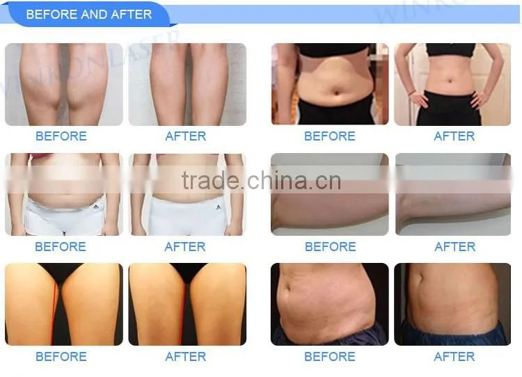 price cryolipolysis / cryolipolysie / cryolipolysis body slimming machine