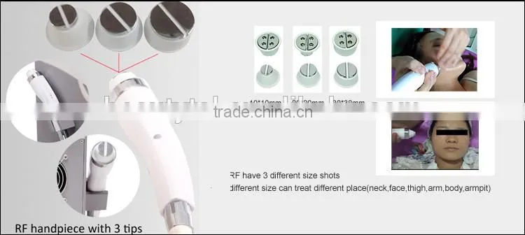 Economy laser epilation system for permanent